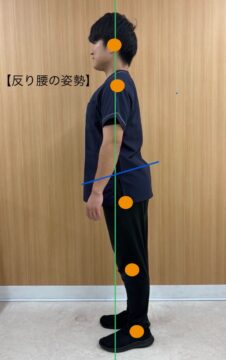 【悪い姿勢】反り腰の画像