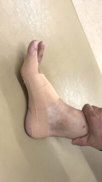 【外反母趾】痛みが出る場合のテーピングの画像